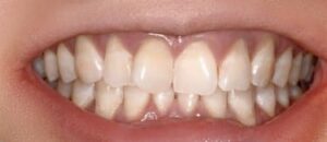 Cosmetic Dentistry Before Treatment