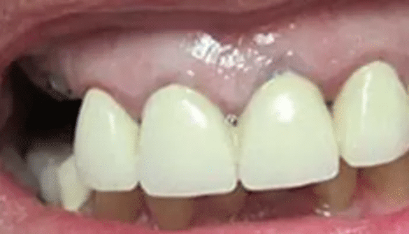 Full Mouth Reconstruction Before Treatment