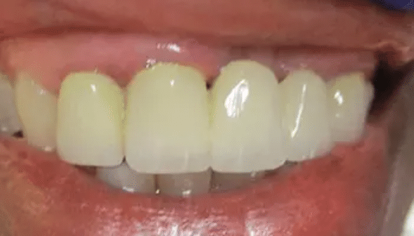 Smile Makeover Before Treatment