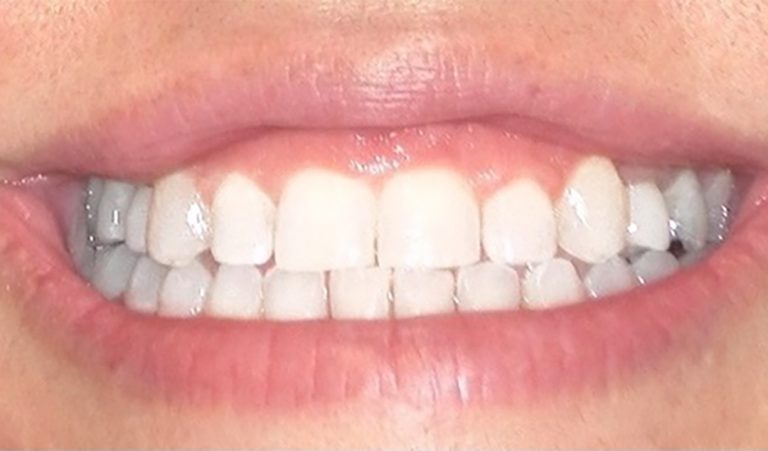 Implant-and-Veneer-After-1-resize