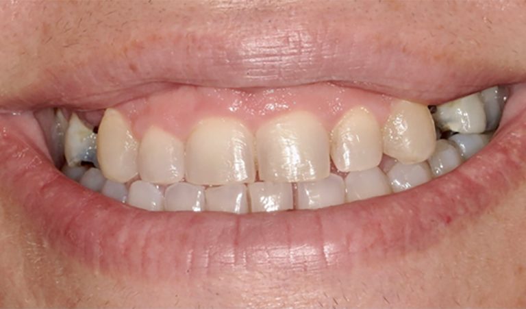 Implant-and-Veneer-Before-1-resize