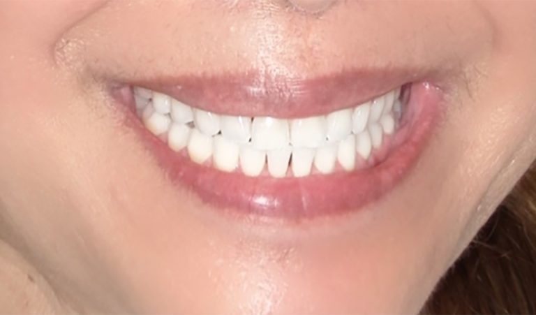 Invisalign-After-1-resize