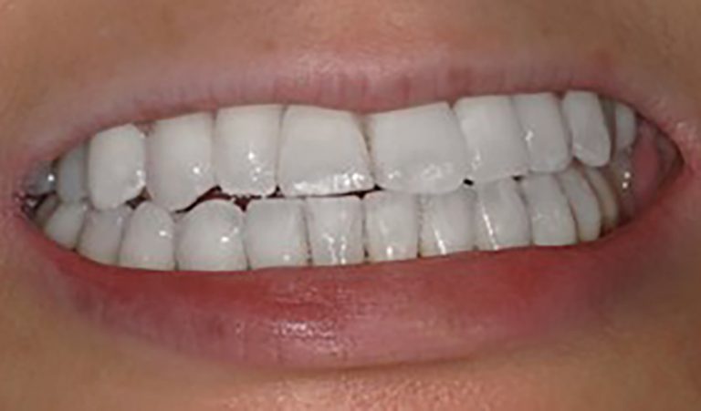 Invisalign-After-2-resize