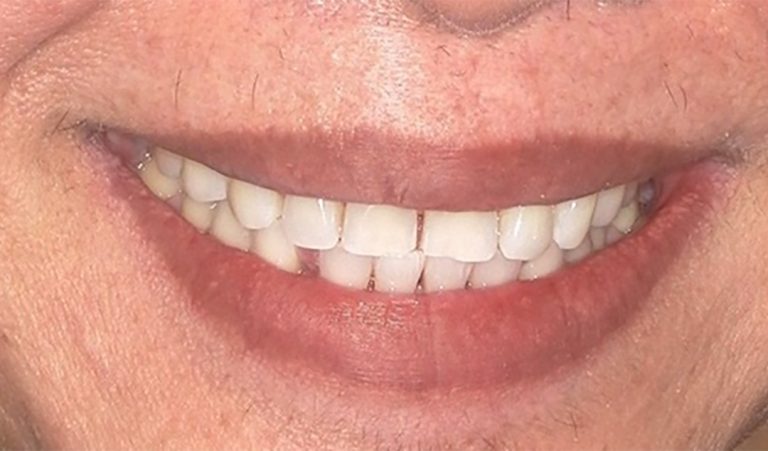 Invisalign-Before-1-resize