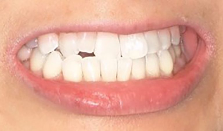 Invisalign-Before-2-resize