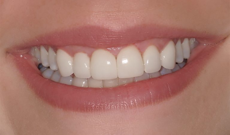 Porcelain-Veneer-After-1-resize