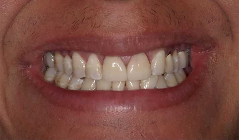 Porcelain-Veneer-After-2-resize