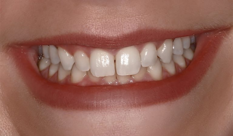 Porcelain-Veneer-Before-1-resize