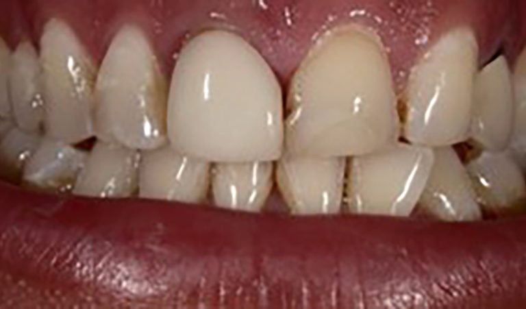 Porcelain-Veneer-Before-2-resize