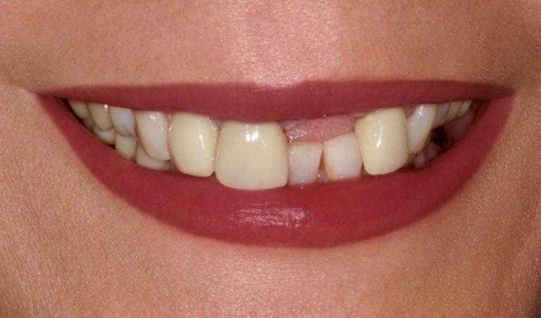 Single-Implant-Before-1-resize