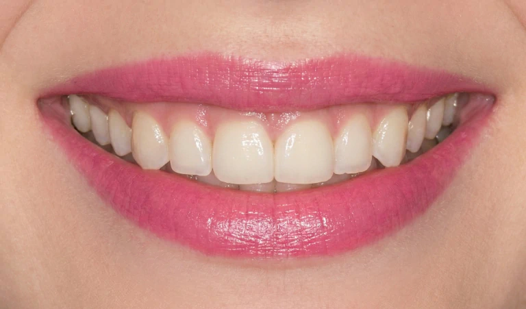 Procelain_Veneers_After