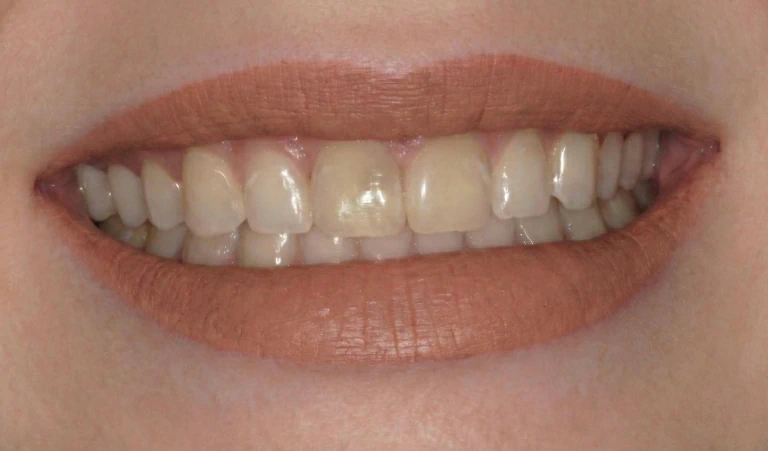 Procelain_Veneers_Before